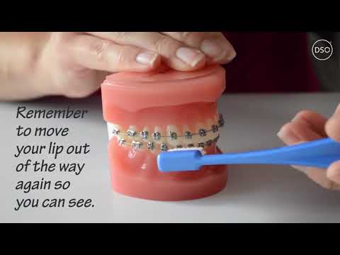 How do I brush with braces?