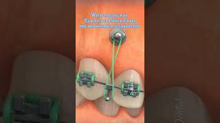 Gummy Smile Correction