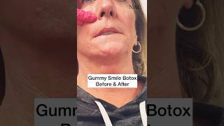 Gummy Smile Botox Before & After #botox #antiaging #gummysmilebotox