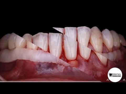 Gum recession treatment