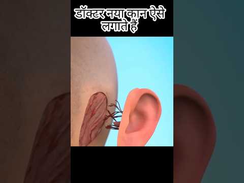 डॉक्टर नया कान ऐसे लगाते हैं