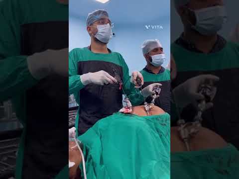 surgeryLapChole #trending #doctor#surgerysuccess  #surgeonlife#brotherhood #hospital#nursing