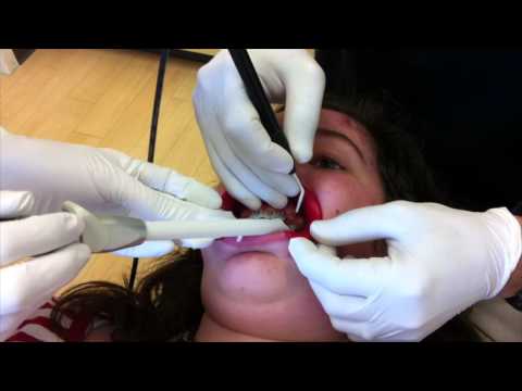 Surgery for Impacted Cuspid: Nirenblatt Orthodontics