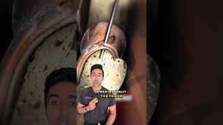 How Limb Lengthening Surgery Actually Works