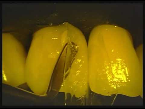 Bioclear Veneers - Fixing Black Triangle Gaps in Teeth