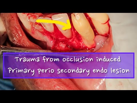 A case of management of trauma from occlusion