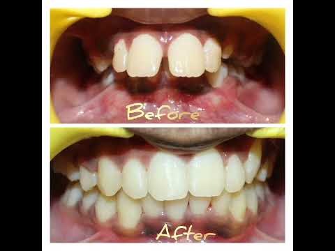 whatsnew#stayhealthy#bestkidsdental#childdentalcare#Bracestreatment#medavakkam#orthodontictreatment