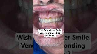 Looking for affordable smile options ? Watch this amazing solution ❤️