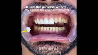 Porcelain veneers. This is how we do it