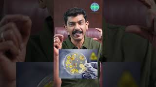 காசநோய் என்றால் என்ன? | Dr.Ravindran Kumeran | Admert Medical Centre #tuberculosis #tb