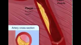 Coronary Soft Plaque Rupture