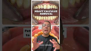 Dental Scaling Procedure Tatar Removal on Teeth | In Office to Hands On Dental Training #shorts
