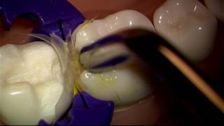 Dr. David Clark: Injection Molded Class II