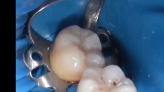 Composite direct restoration on molar (Microbrush  stamp technique)