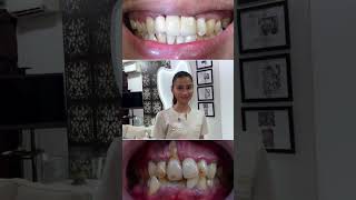 This case involved a non vital dead tooth complicated by advanced periodontitis