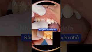 #veneers  #nhakhoacodofa  #dentist  #răngsứthẩmmỹ  #shorts  #short