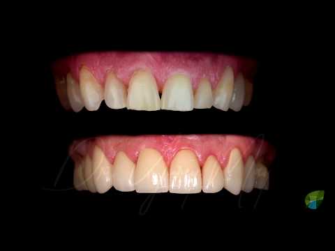 Smile Makeover with 8 Veneers - Top Cosmetic Dentist NY & CT USA | Dr. Yuriy May | Natural Dentistry