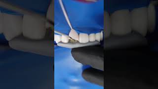 Class IV Composite Restoration – Step by Step