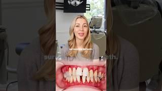What’s gingivitis? What are signs of gingivitis? #dentist #dentistexplains #dentalhealth