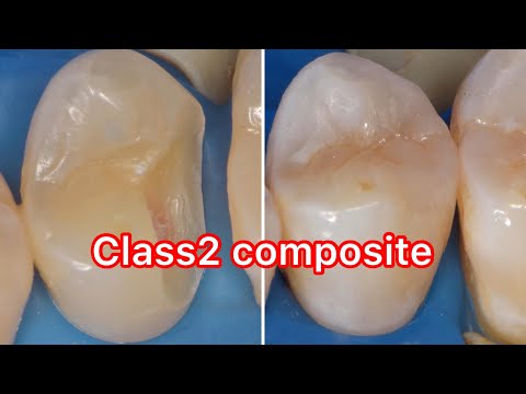 Class II composite resin restoration