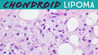 Chondroid lipoma (has lipoblasts, but not liposarcoma!): Basic soft tissue pathology