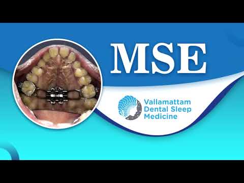 Maxillary Skeletal Expander (MSE) in Dental Sleep Medicine Dr. Jojo Joseph, Vallamattam Dental Sleep