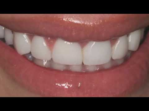 Gum Recontouring -  Dr. Michael Kosdon - Cosmetic Dentist - Manhattan, New York