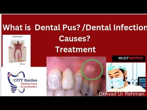 what is Dental Infection /tooth infection /pus in gum