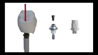 Attention when choosing abutment for screw retained restorations