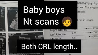 My two baby boys Nt scan reports / placenta/CRL length/Little hands creations 
