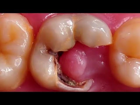 The ultimate journey of ENDORESTO, from start to finish