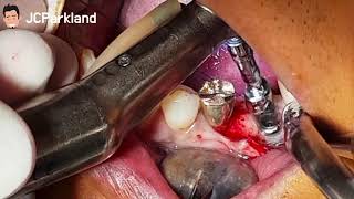 [Implant removal] Explantation with Treaphine bur
