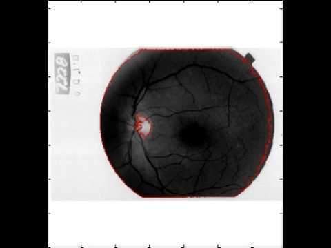 retinaChanVese.avi