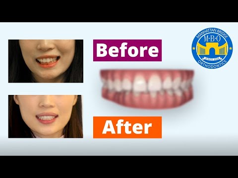 Invisalign Before and After: Correcting Bite