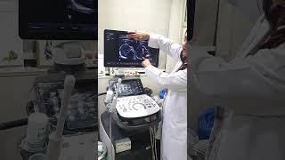 NT scan (Nuchal Translucency) is an ultrasound test usually done between 11 to 14 weeks of pregnancy