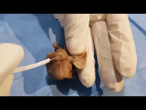 Fetal echo Ebsteins anomaly teaching Dr Pradeep Srinivasan  refer.mediknit.org