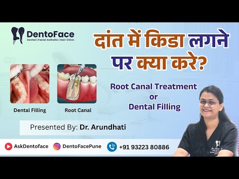 दांत में किडा लगनेपर क्या करे?  रूट कैनाल treatment or tooth filling. @AskDentoface-tc9xs 