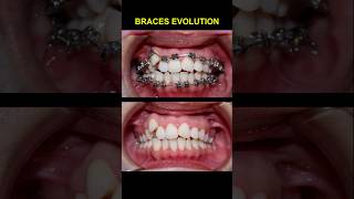 Braces transformation, croooked teeth #braces #orthodontist #bracket #dentist