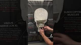 What an Atlas Spinal Misalignment looks like. #shorts #migraine #headache #neckpain #migrainerelief