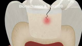 Advanced Dental Materials (ADM). Use of the revolutionary Fibrafil Cube & Flow reinforced composite.