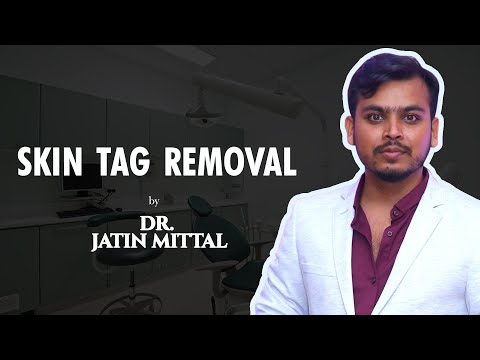 Skin Tag Removal By DR. Jatin