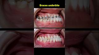 Braces underbite teeth. 48 months duration #braces #orthodontist #dentist