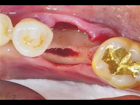 Bone Expander