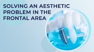 Screw retained restoration performed on the frontal area. Working with composite material