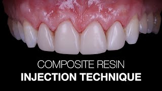 Composite Resin Injection Technique: setp by step