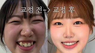 Ultra-Realistic Orthodontic Vlog: 1 Year In (The Day I Get My Braces Tightened)