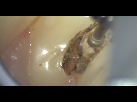 Caries Removal and indirect pulp capping