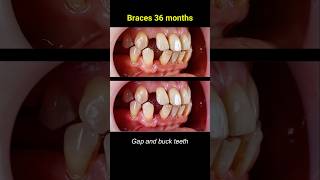 Braces as magic :) #braces #orthodontist #dentist