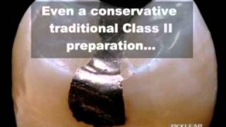 Bioclear - Cavity prep