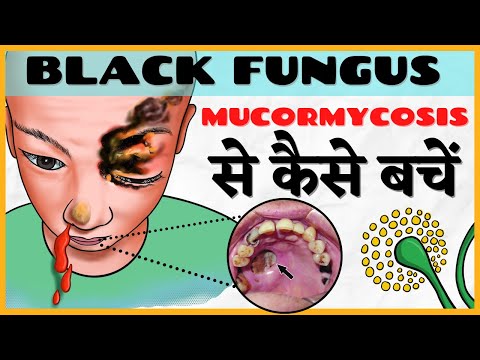 Black Fungus/Fungal Disease in covid (Mucormycosis): Corona update in Hindi (ब्लैक फंगस के लक्षण)